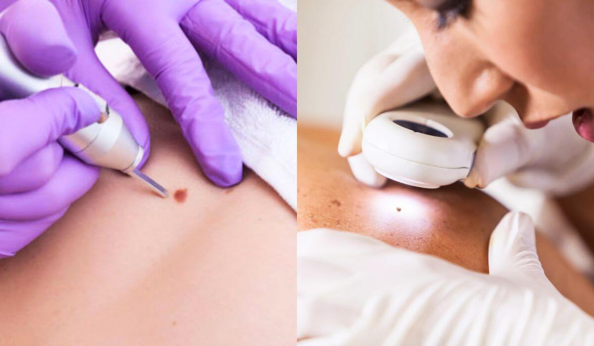 DIY Bands And Patches For Skin Tag Removal Can Be Used