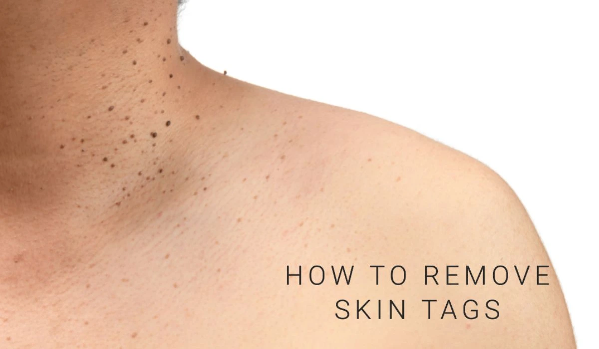 How To Remove Skin Tags Everything You Need To Know!