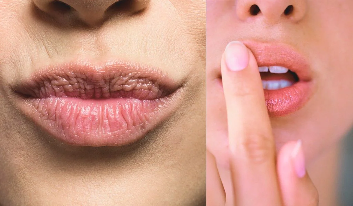 Tips To Get Rid of Lip Scars