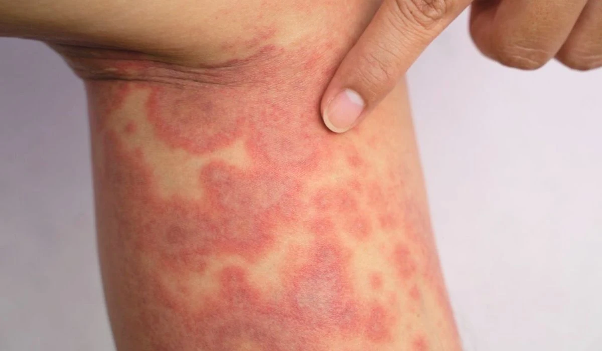 Understanding Eczema Scars: How To Get Rid Of It?