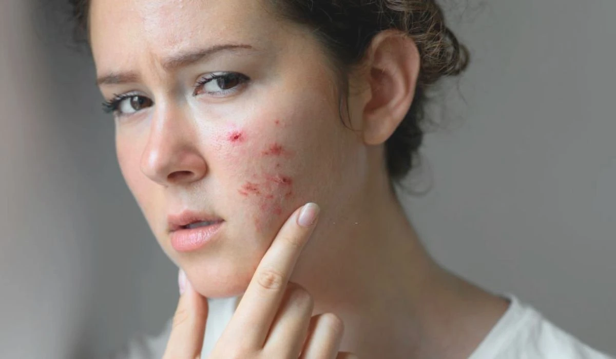 Causes Of Rosacea