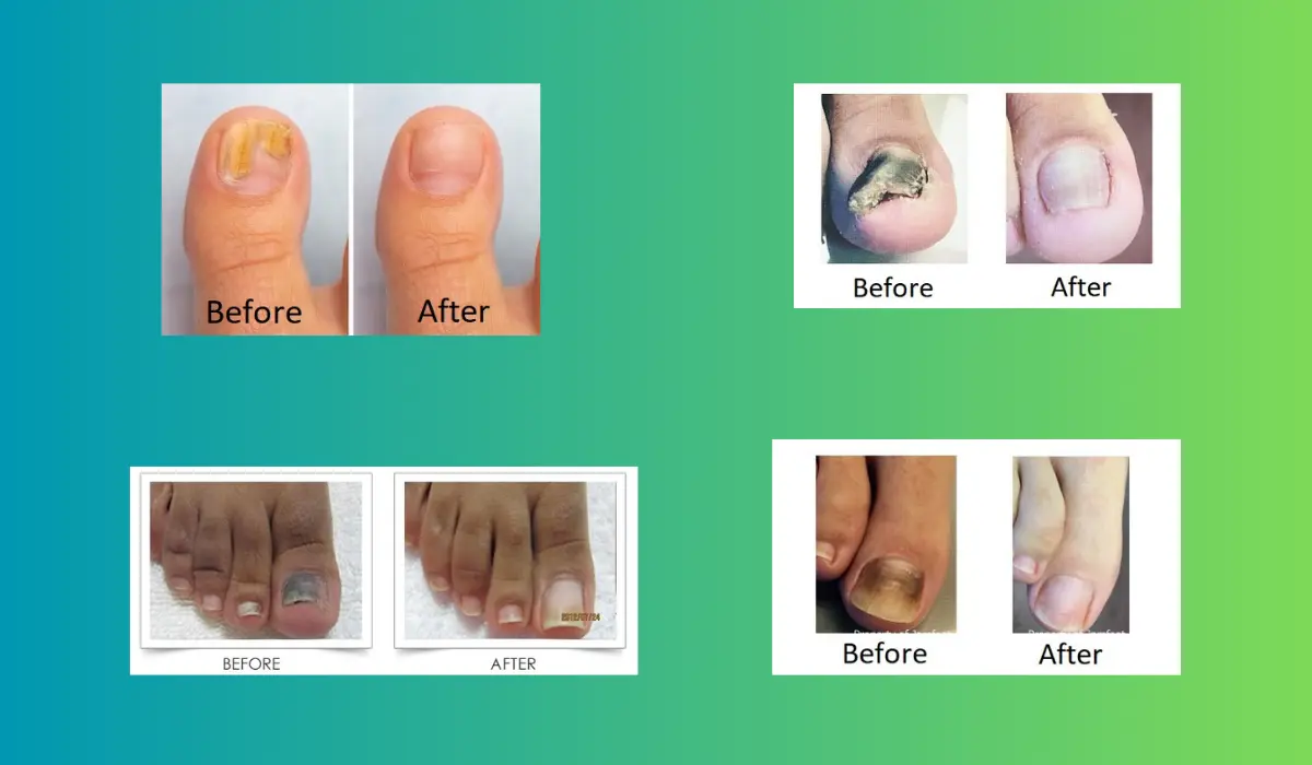 Fungal Nail Treatment Darlington - Laser Fungal Nail Treatment