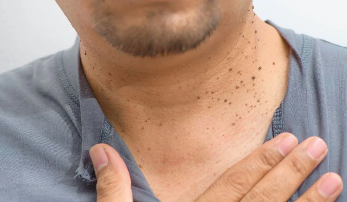Skin Tag Removal 3 Effective Methods And Natural Remedies