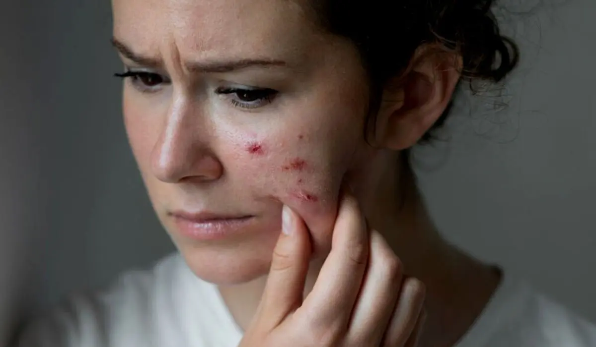 Symptoms Of Oily Skin And Pimples