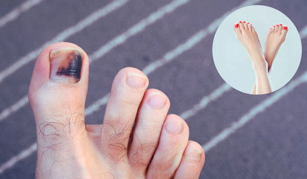 Toenail Color Changes And Related Health Signs