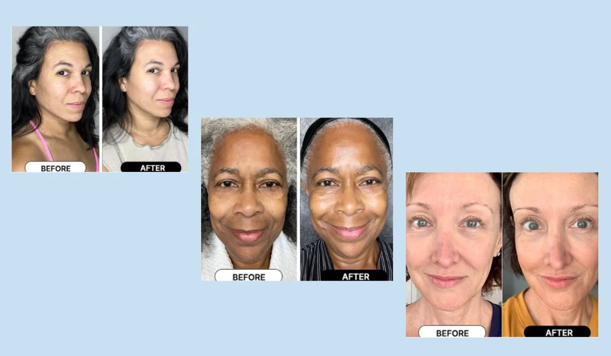 South Beach Skin Lab Before And After Results