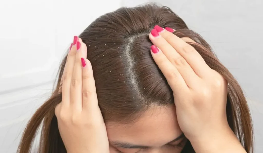 Understanding Dandruff 