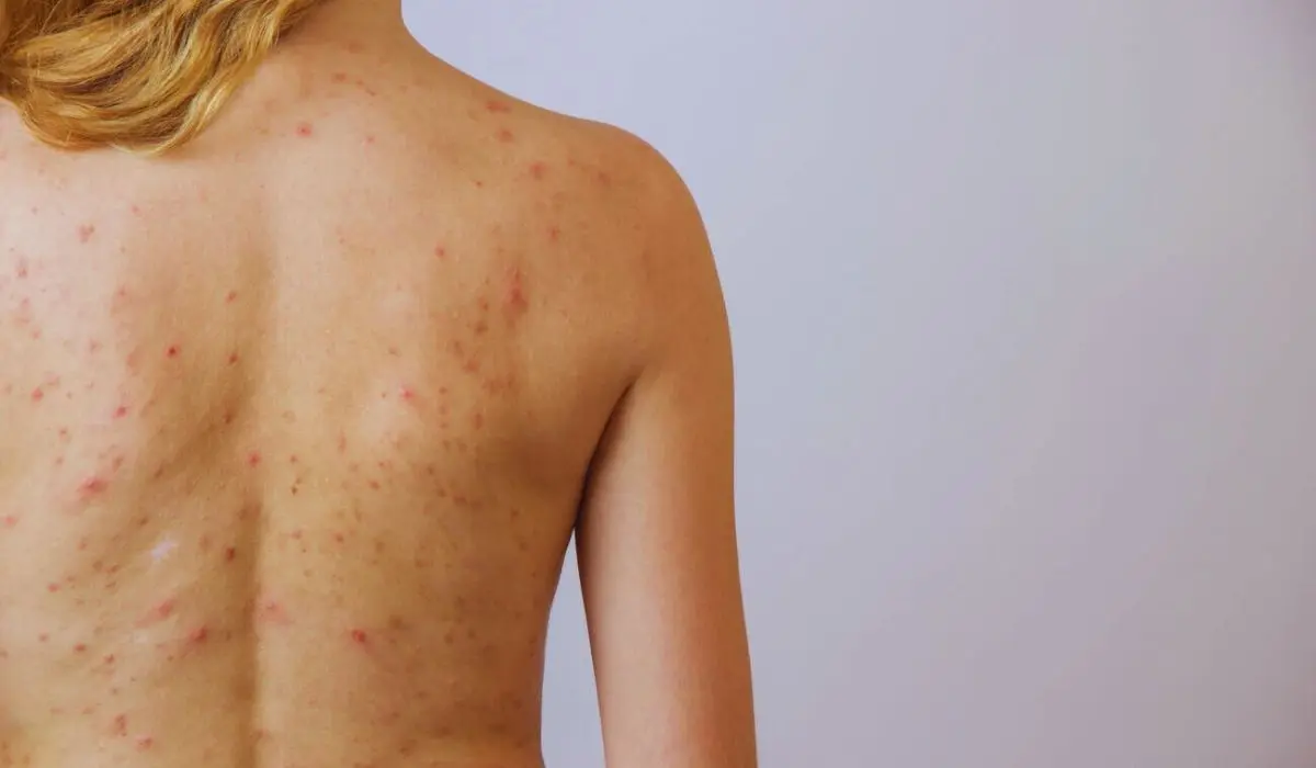 what causes back acne in females