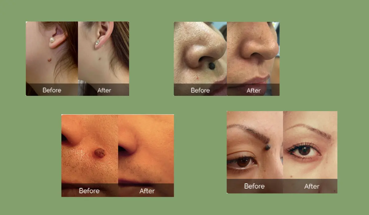Deor Skin Tag Remover Before And After
