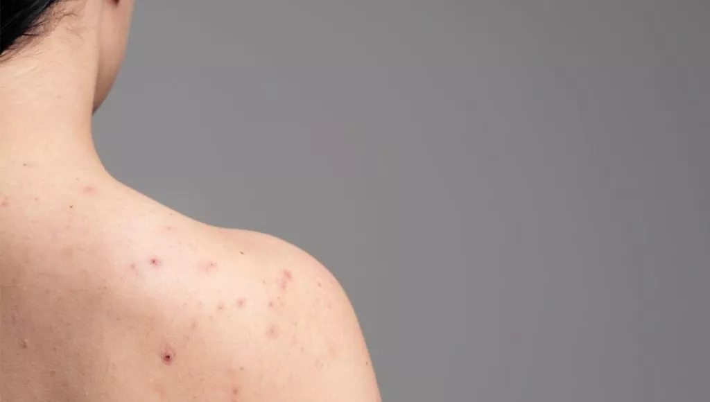 Arm Acne Causes and Remedies Explained!