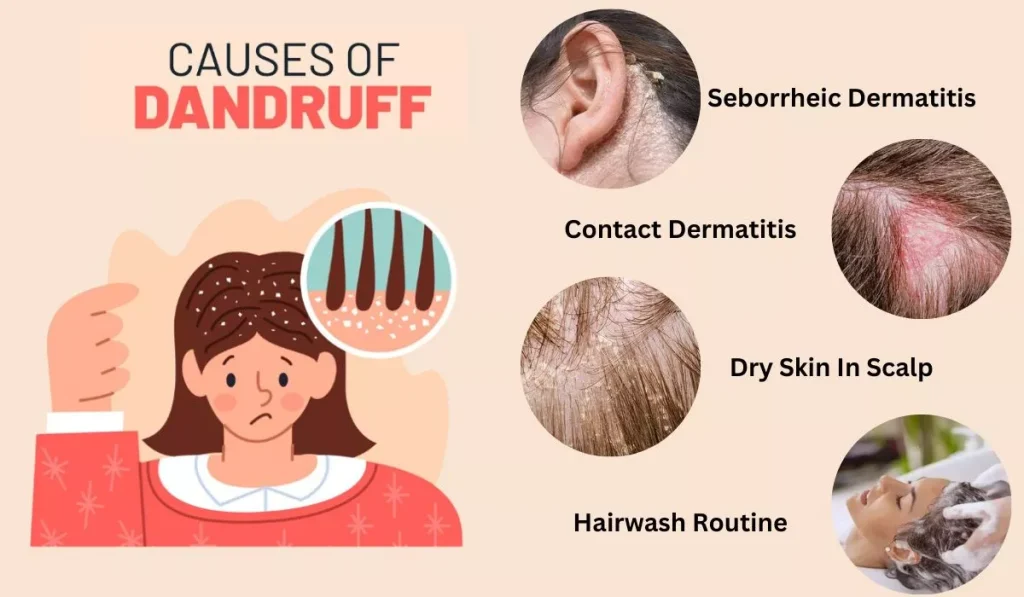 Causes of Dandruff 