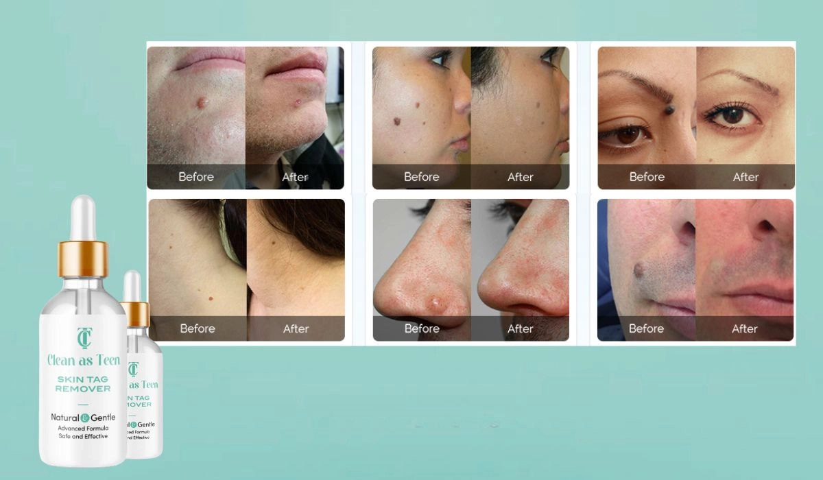 Clean As Teen Skin Tag Remover Before And After