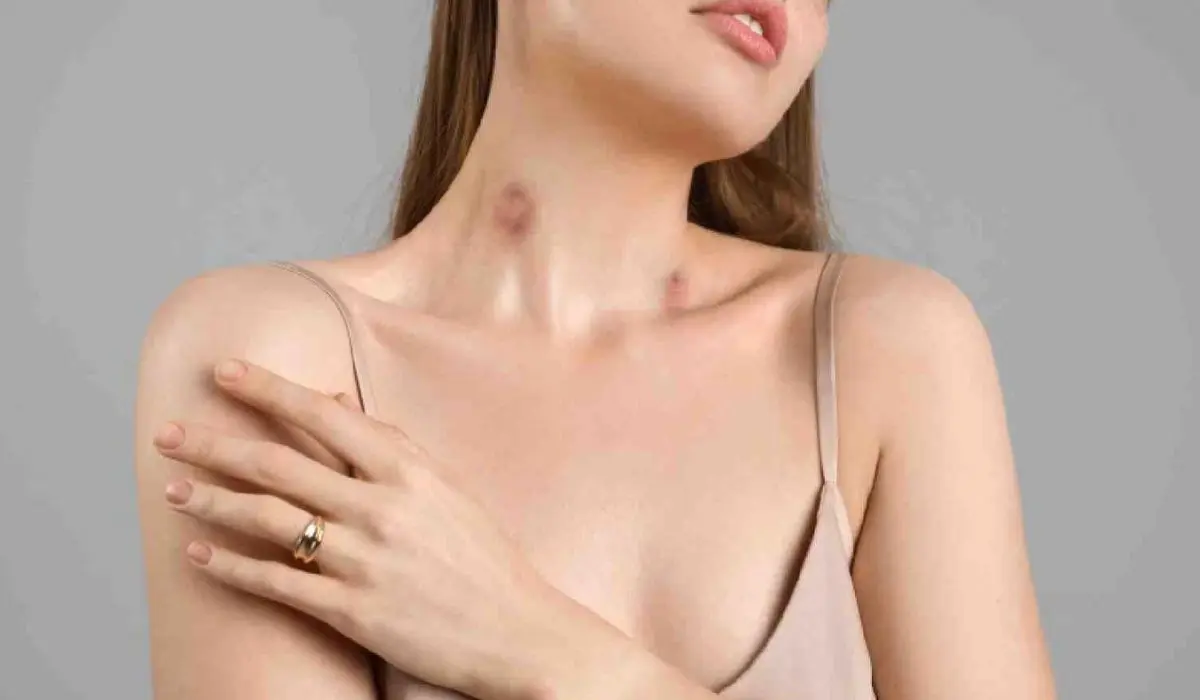 How To Remove Hickey