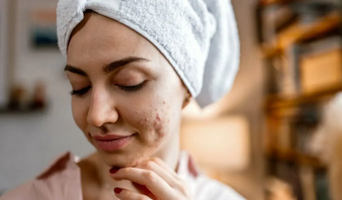 Remove Dark Spots Caused By Pimples