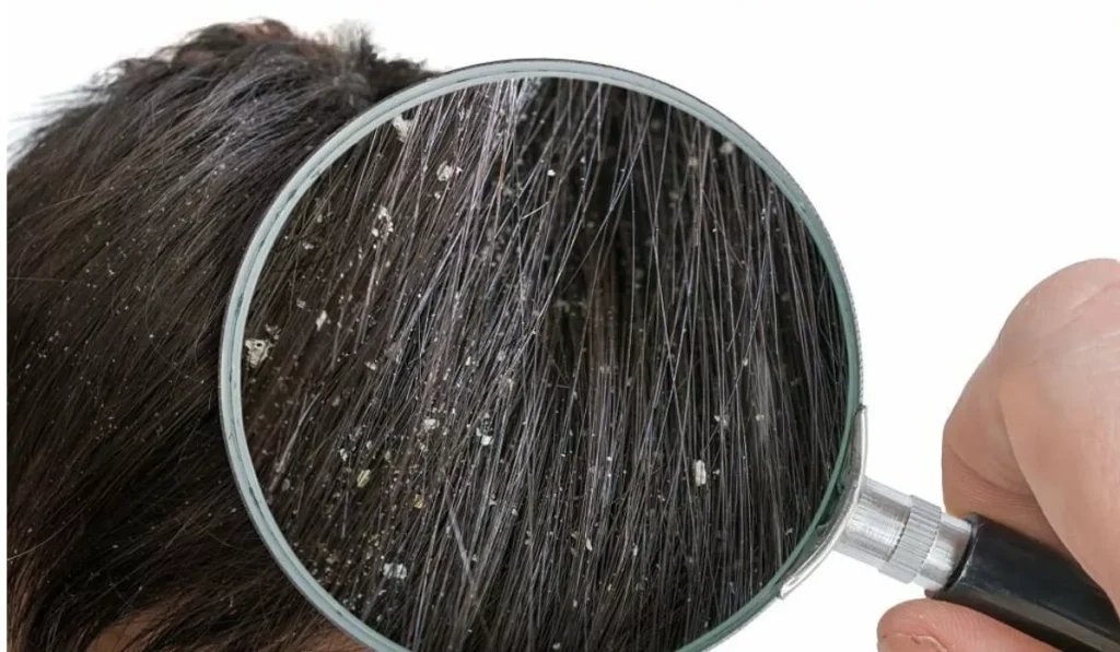 Tackle Dandruff Naturally