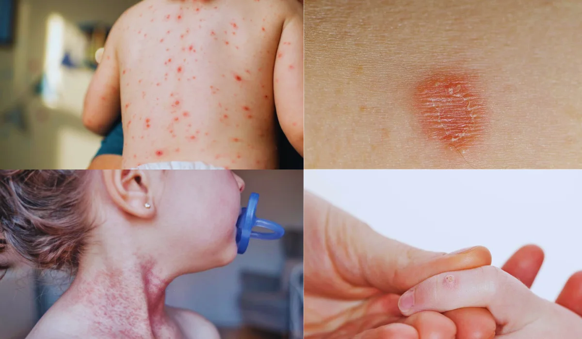 Types Of Skin Infections