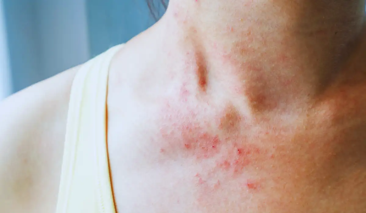 Atopic Eczema Skin Disease