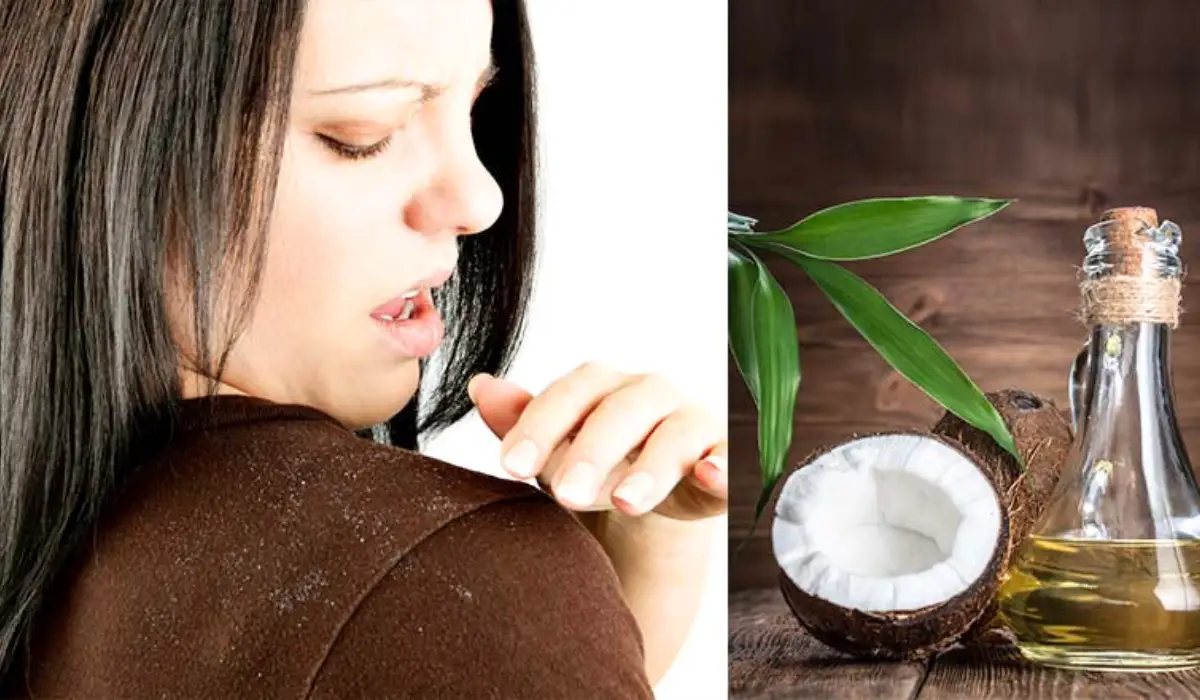 Benefits of Coconut Oil for Dandruff