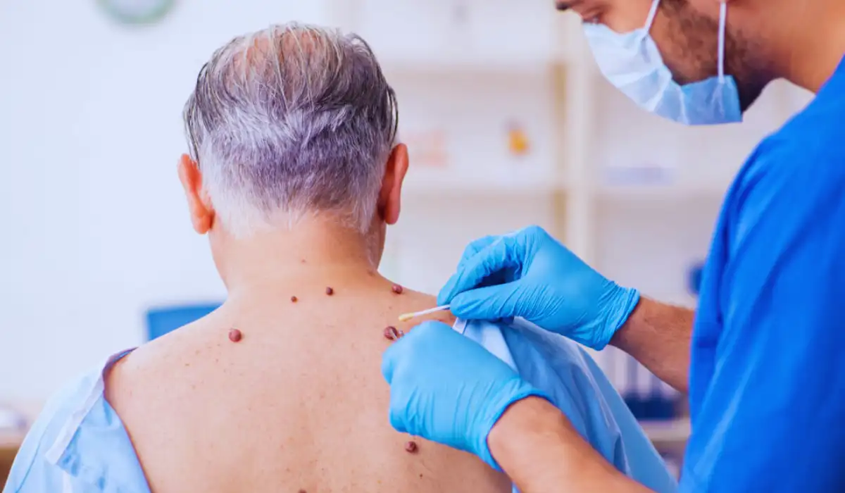 Benign Skin Tumors Treatments