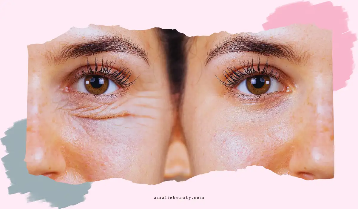 Best Treatment For Under-Eye Wrinkles