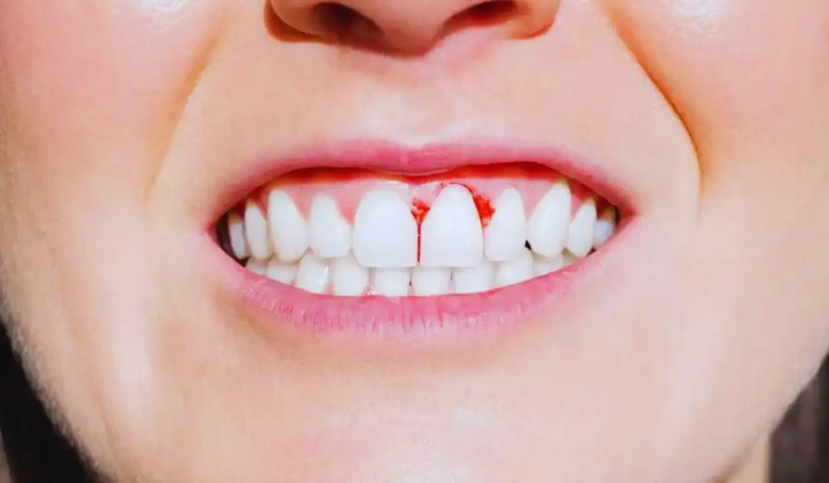 Bleeding Gum Causes