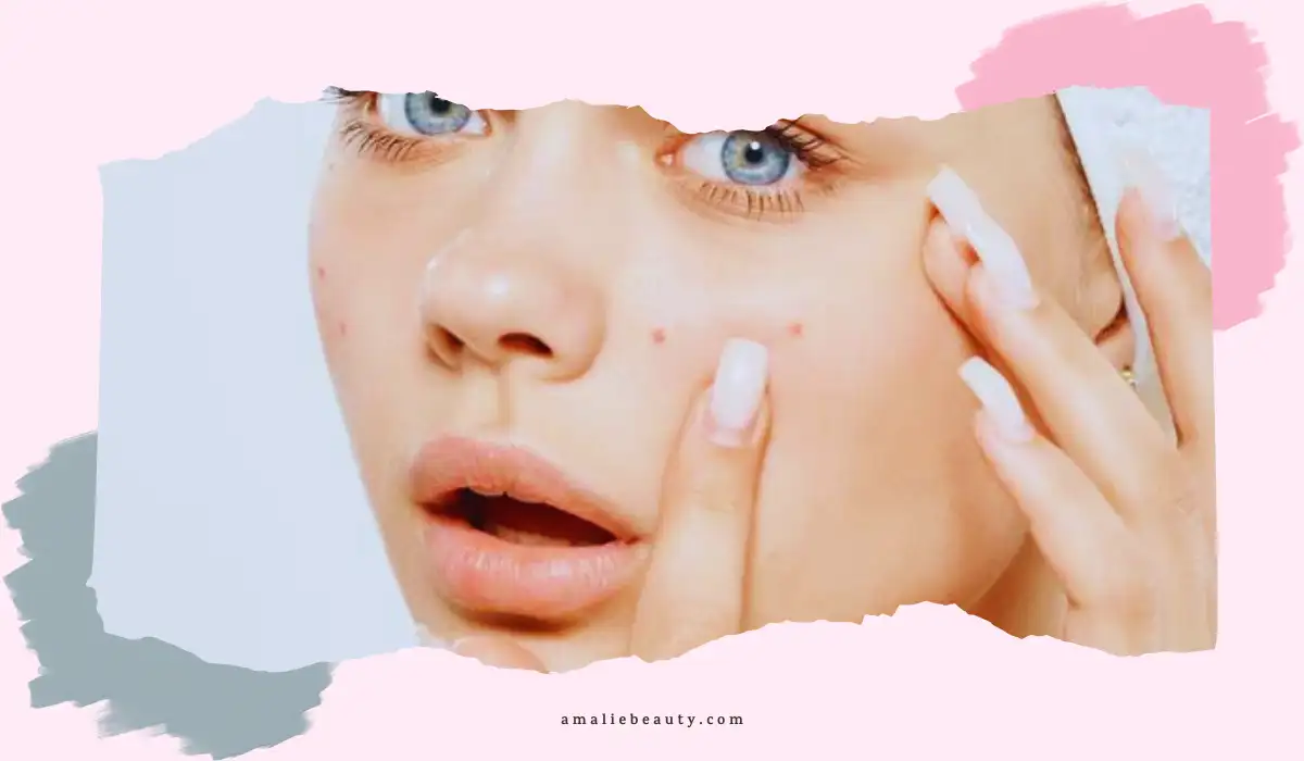 Can Niacinamide Cause Acne