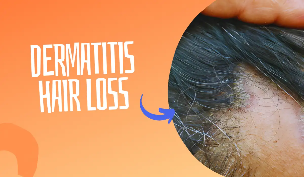 Dermatitis Hair Loss