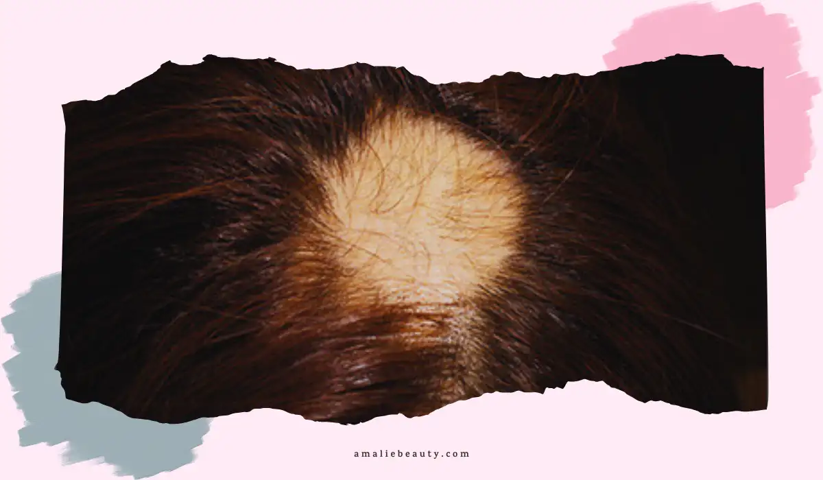 Lupus Alopecia Treatment