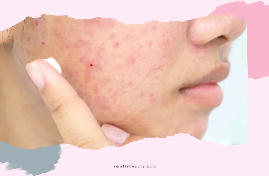 Tretinoin Help With Acne Scars