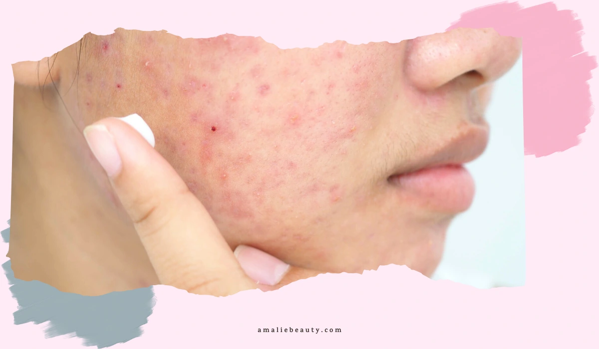 Tretinoin Help With Acne Scars