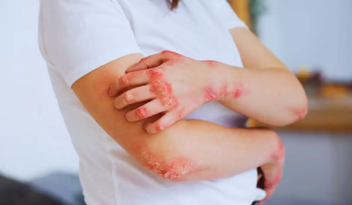 Spongiotic Dermatitis Skin Condition