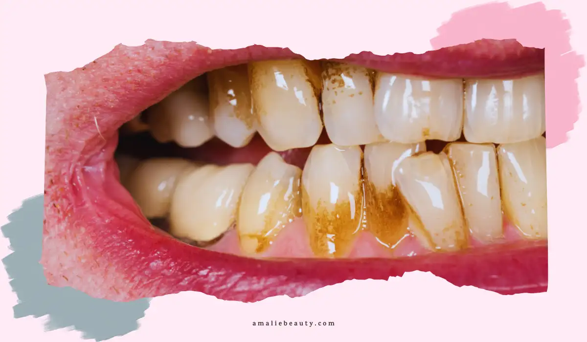 Stains From Teeth