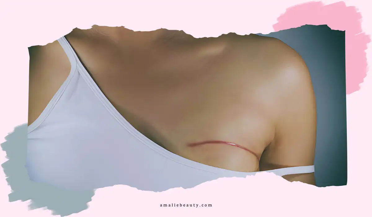 Breast Reduction Scar Treatment